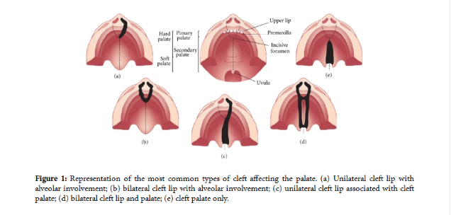 A diagram showing the common types of cleft lip and/or cleft palate. 