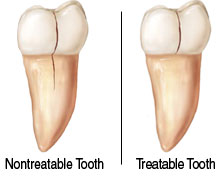 This split screen diagram reveals a tooth with a crack that can be treated and one with a fracture so deep that the tooth cannot be saved.