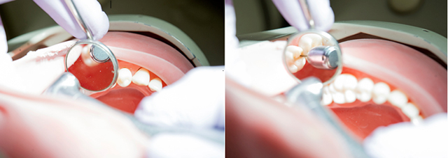 This side-by-side photo illustration shows how when held incorrectly, the handpiece can actually block the view of the tooth in the dental mirror, and on the right, positioning has allowed for a clear view of the tooth. 