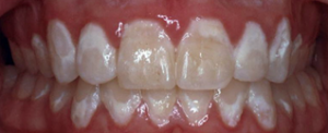 An example of white spot lesions following orthodontic treatment