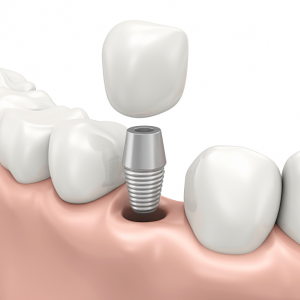 This diagram shows how a dental implant is restored using an abutment and crown. 