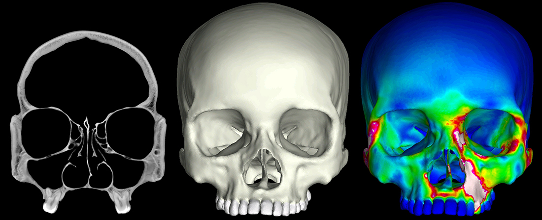 X-ray CT “slices” were used to construct 3D finite element models of human crania. These models were then subjected to a series of mechanical analyses that simulate feeding. The image to the far right depicts a finite element model during a bite on its left first premolar. “Warm” colors indicate regions of high strain, while “cool” colors indicate regions of low strain.