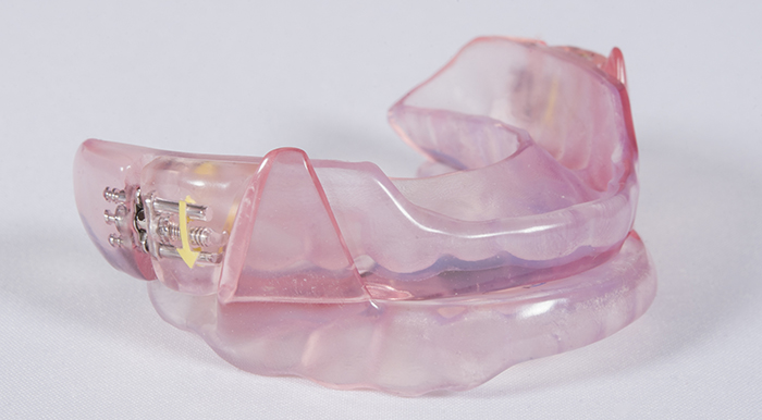 The second device in the study, the SomnoDent Flex, uses a bilateral thrust mechanism to prop the mouth open during sleep.