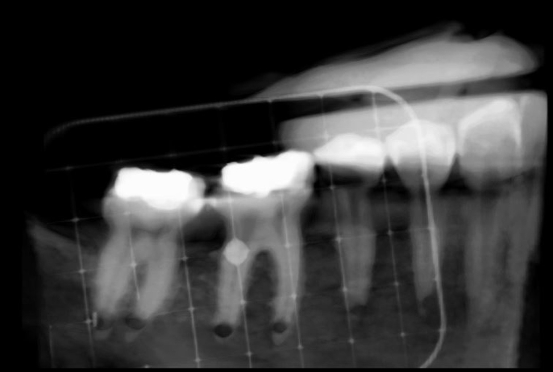 An X-ray of a patient's jaw, with a grid overlaying it